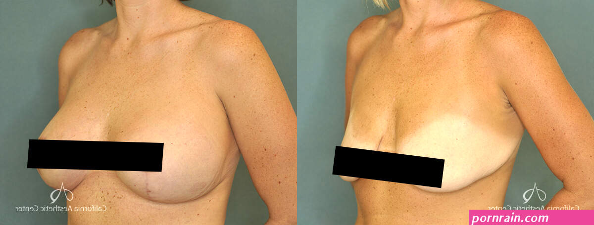 boob lift cost