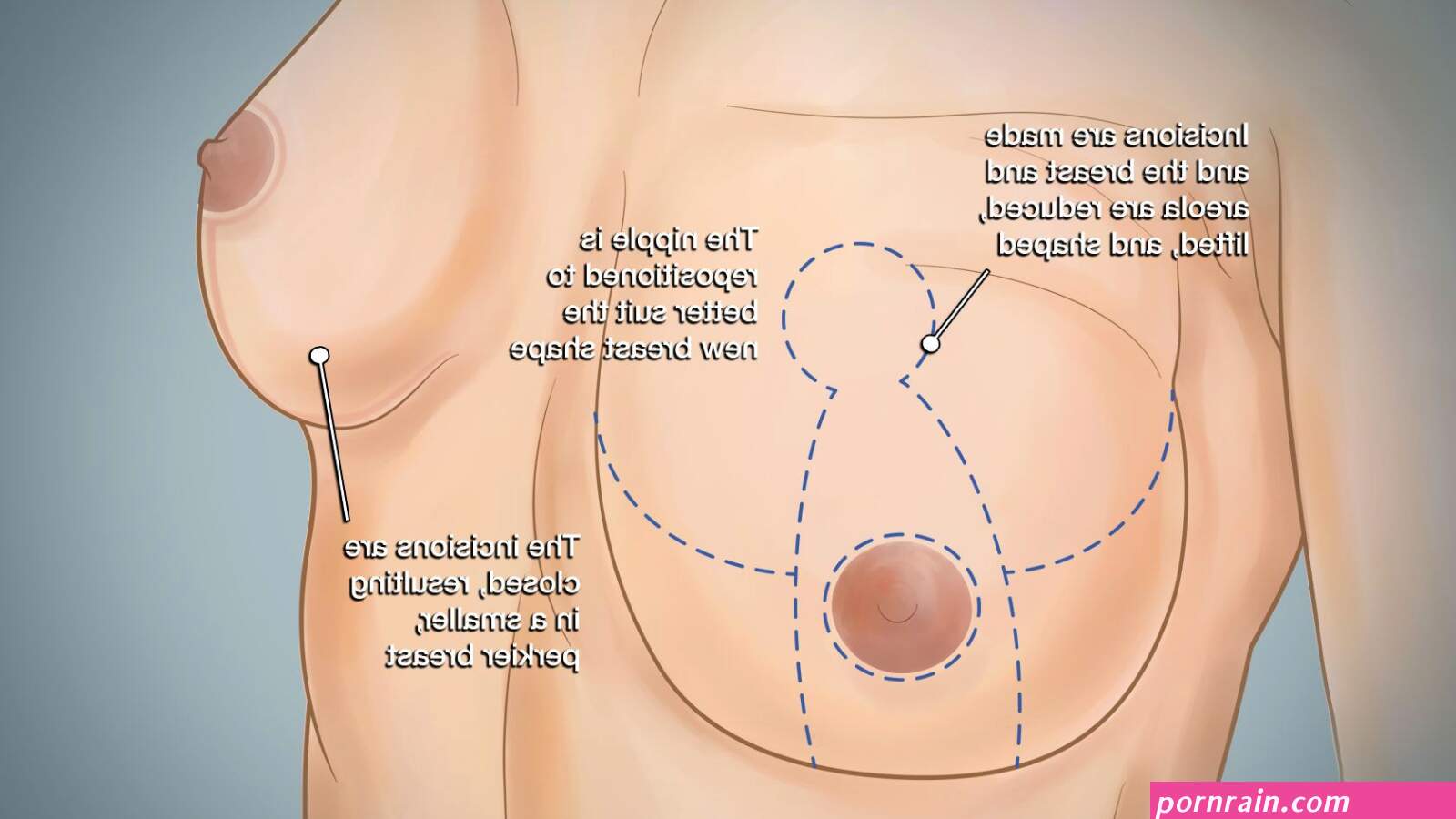 boob lift cost
