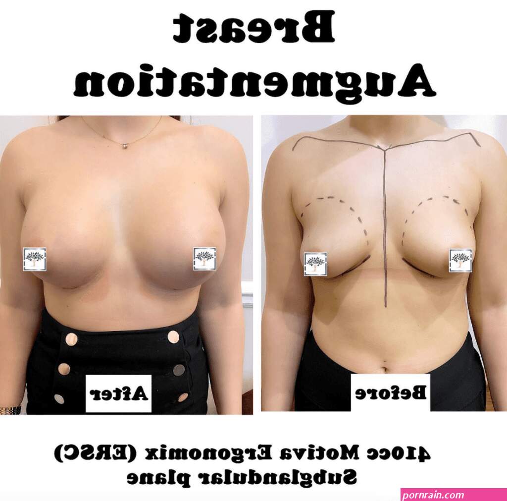 What Do You Need to Know About Gummy Bear Breast Implants?