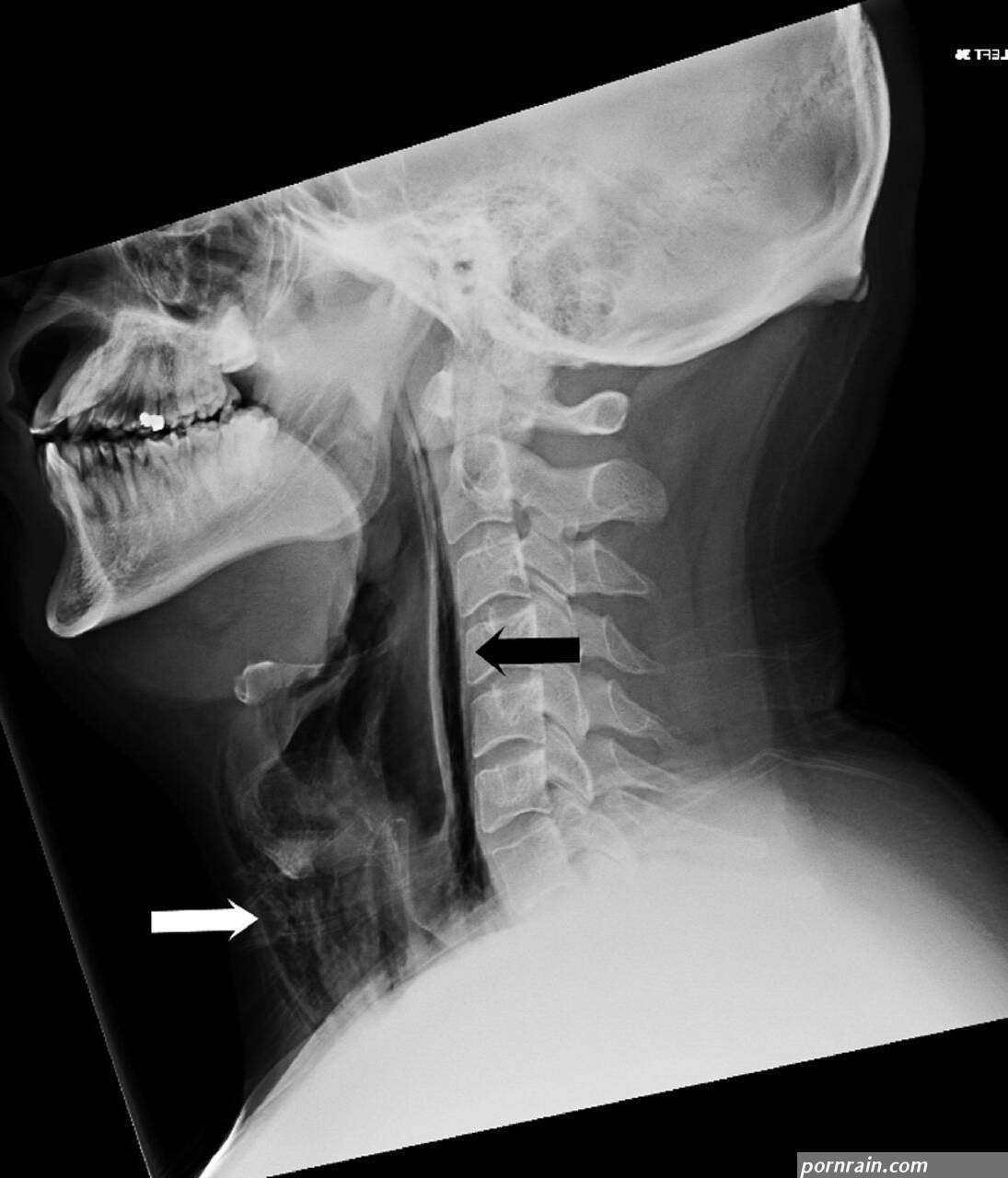 X ray deep throat image. xxx tube 3gp.