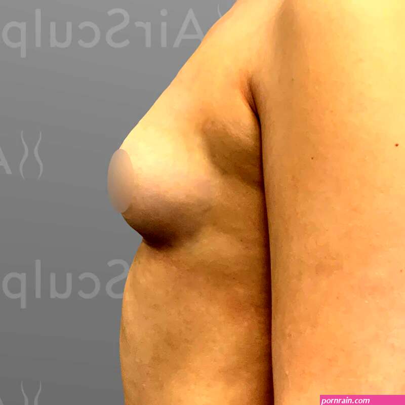 Charlotte Breast Augmentation