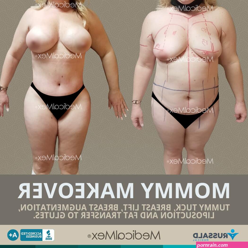 Mommy Makeover Surgery in Tijuana Mexico