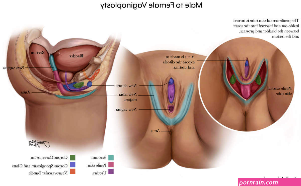 Vaginoplasty for Gender Affirmation