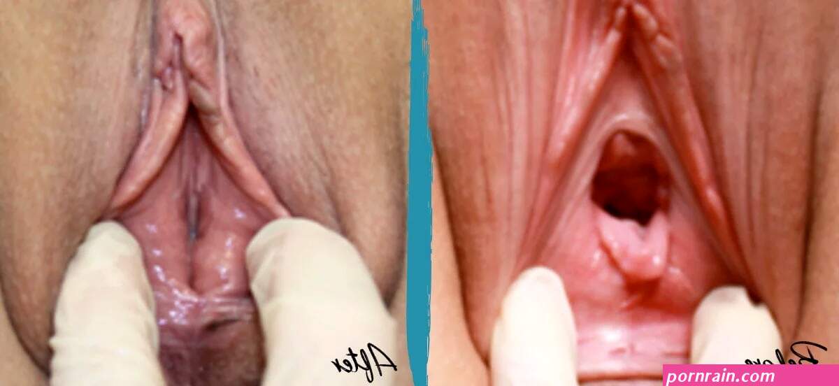 Vaginal Rejuvenation Before and After Pictures
