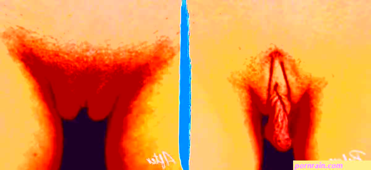 Labial Puffing Vaginal Fat Transfer Before and After Pictures