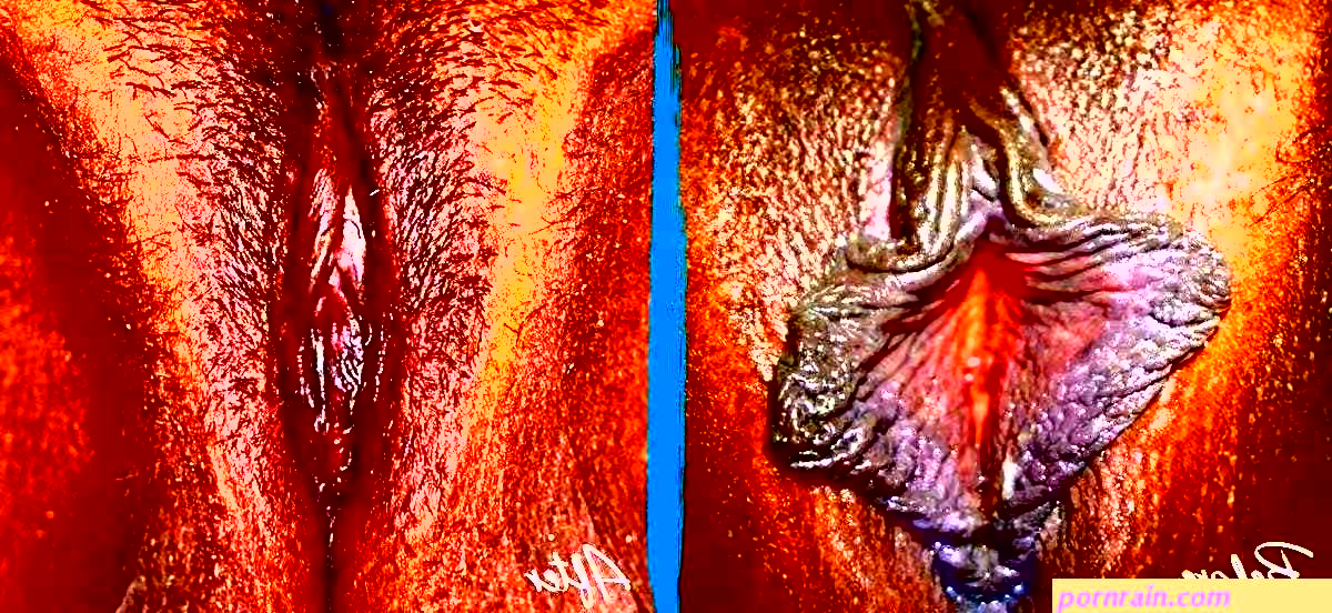 Vaginal Rejuvenation Before and After Pictures