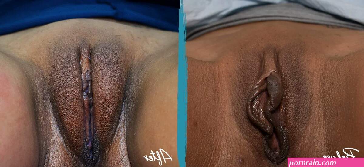 Labial Puffing Vaginal Fat Transfer Before and After Pictures