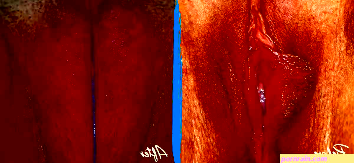 Labial Puffing Vaginal Fat Transfer Before and After Pictures