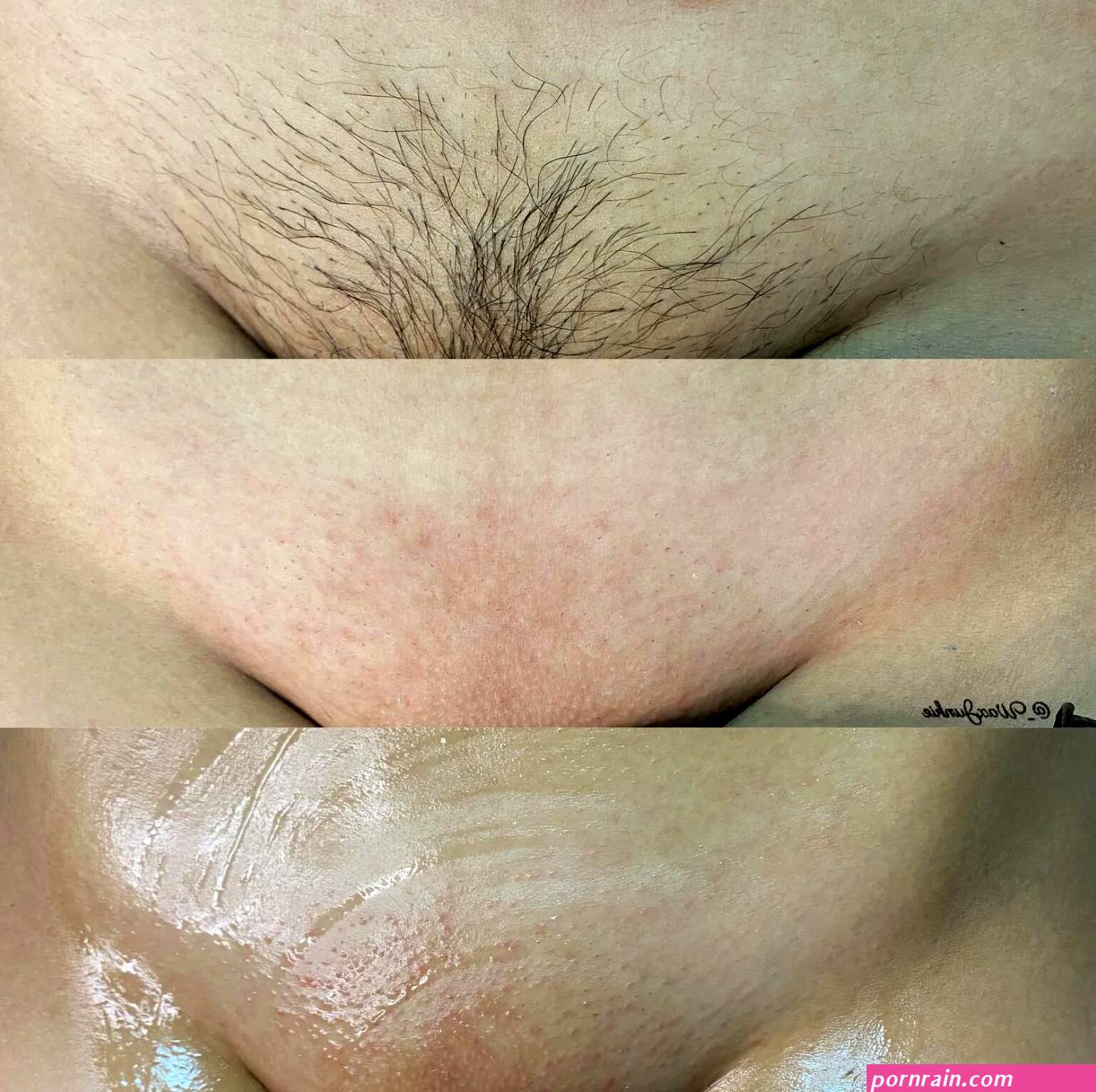 Vajacial Before and After Pictures