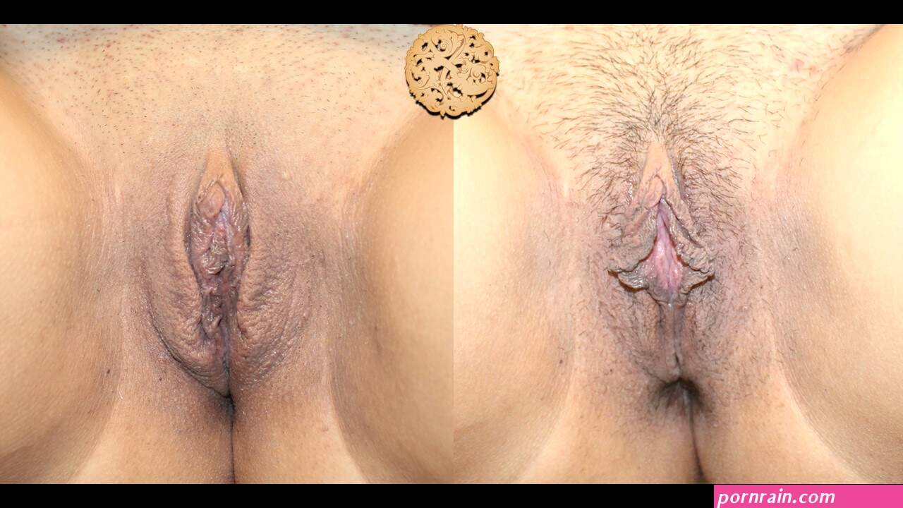 Vaginal