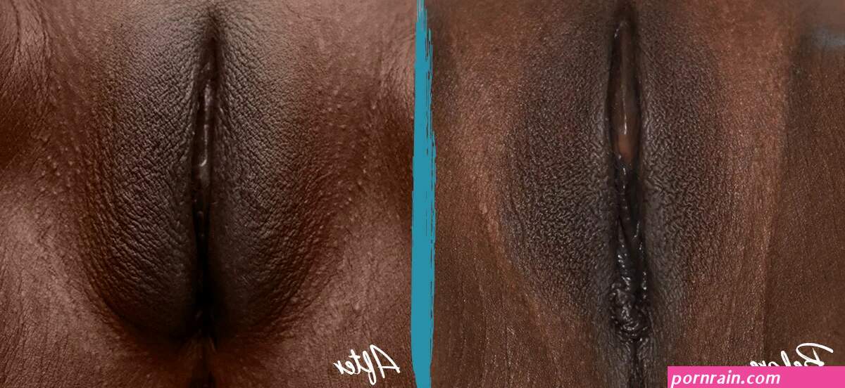 Labial Puffing Vaginal Fat Transfer Before and After Pictures
