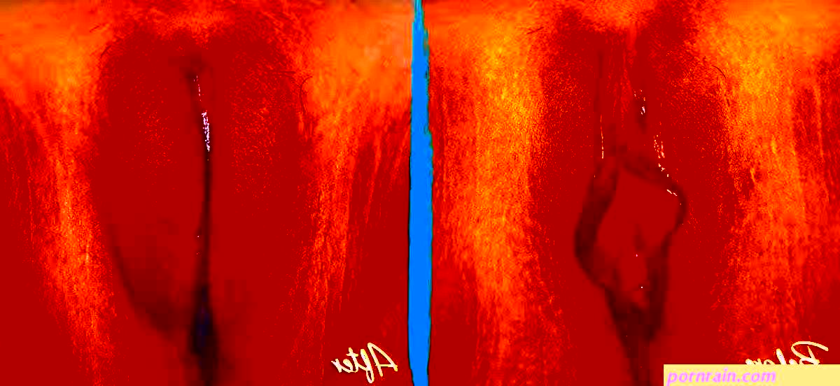 Labial Puffing Vaginal Fat Transfer Before and After Pictures