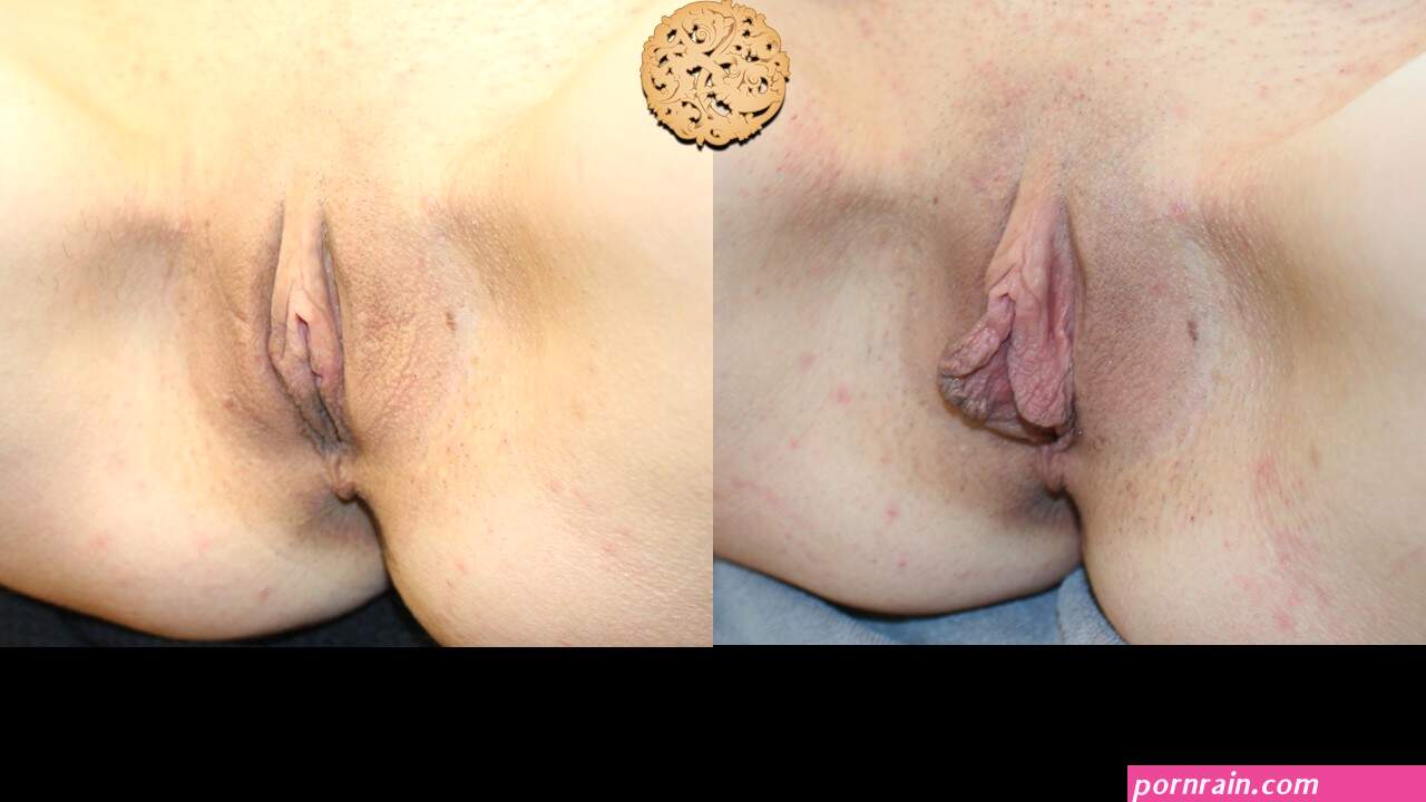 Vaginal