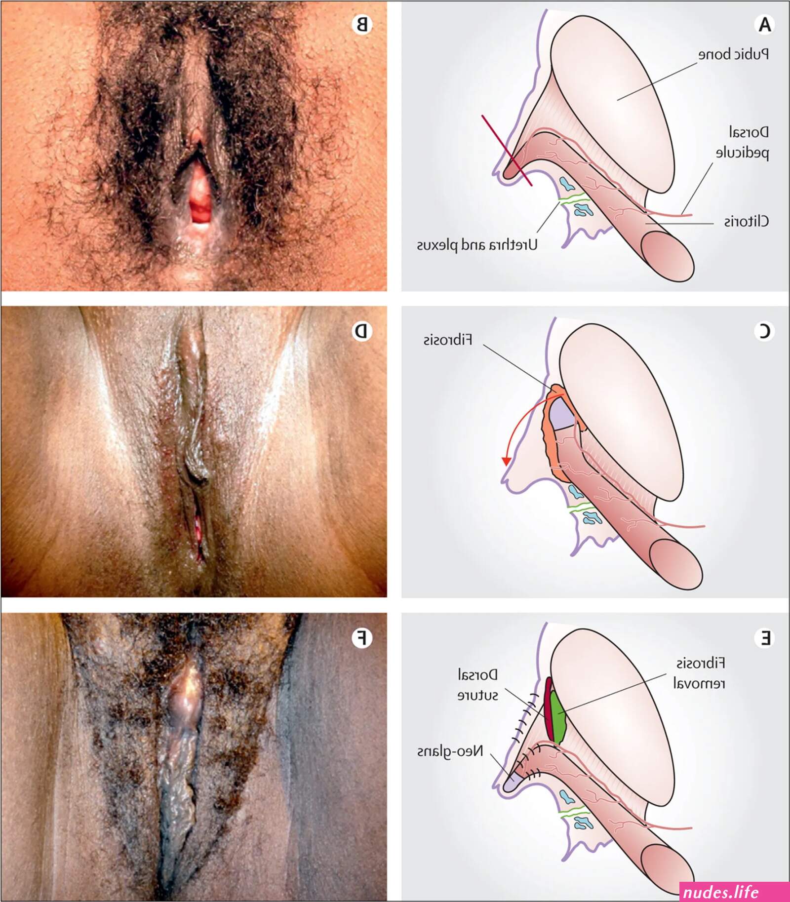 clit cut clitless clitoridectomy