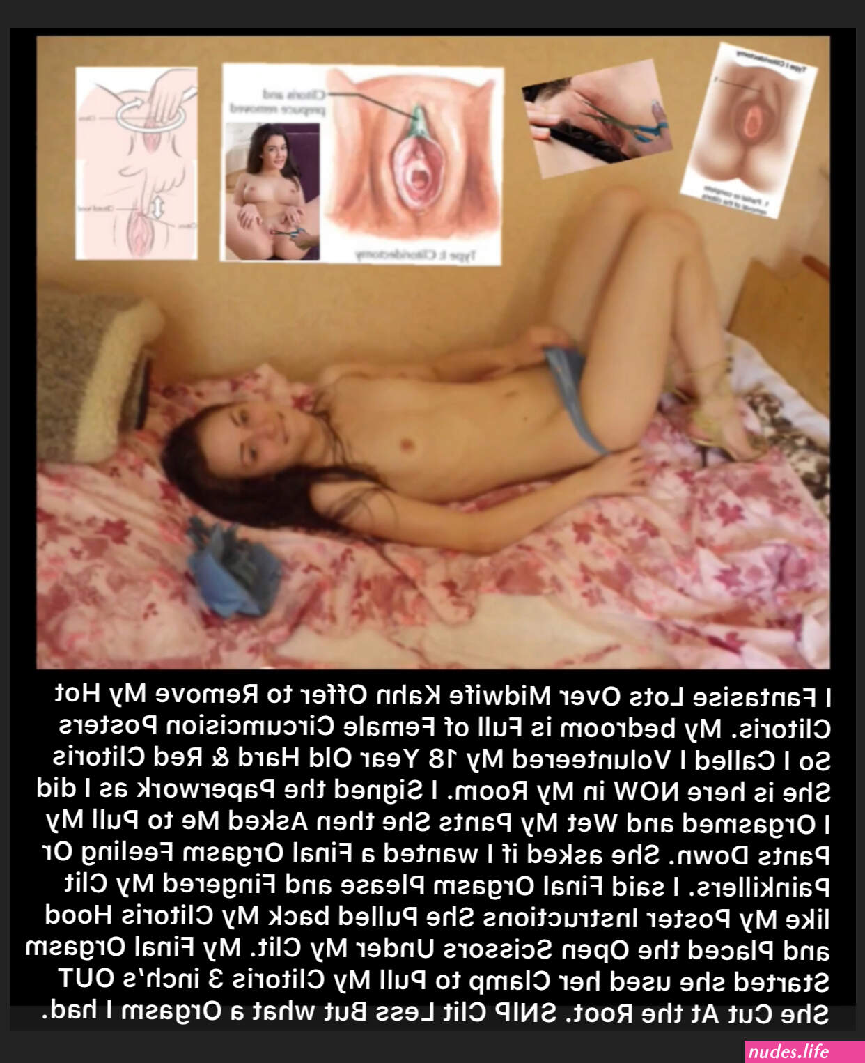 Voluntary Clitoris Circumcision 2