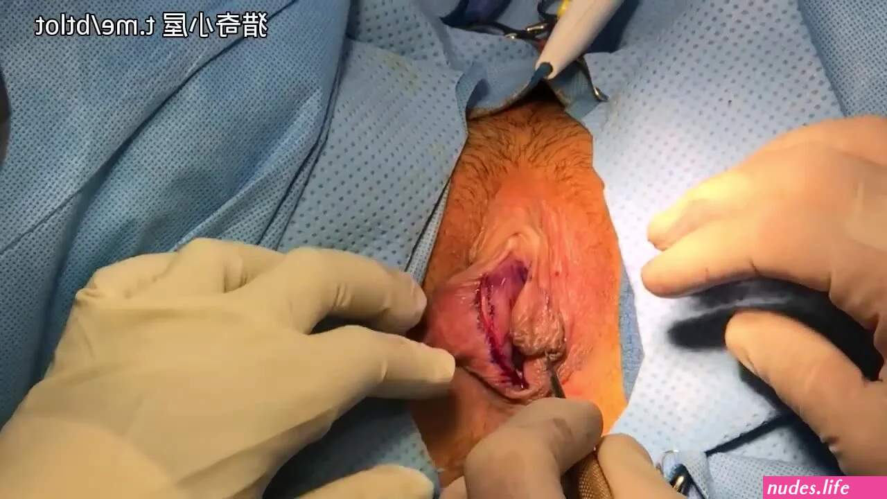 Female circumcision