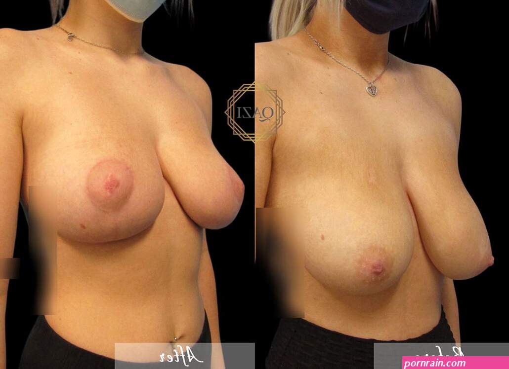 wp-contentuploads202204breast-l...