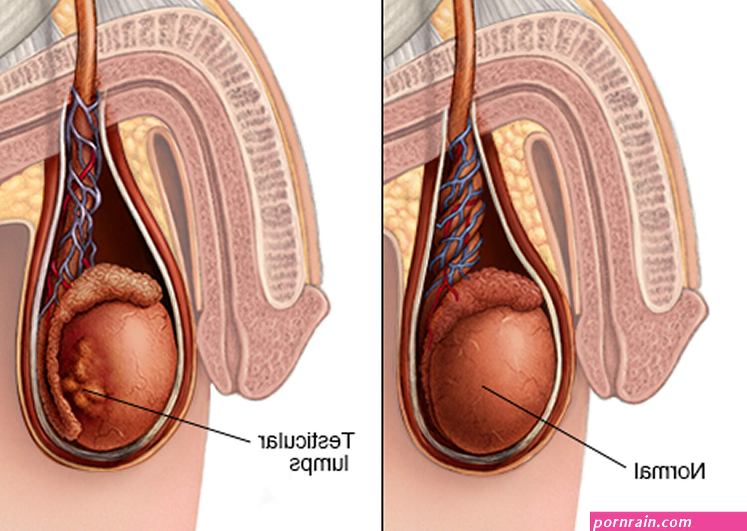 Testicular Cancer