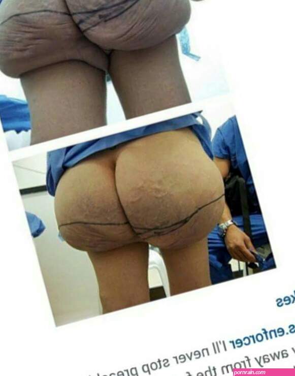 Enhancing Your Beauty: The Truth About Fake Butts