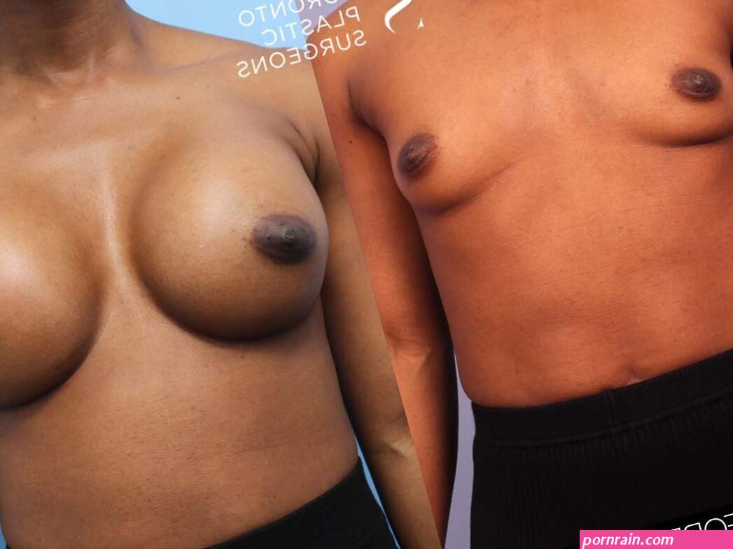 Whats the Difference: Fake Boobs vs. Real Boobs