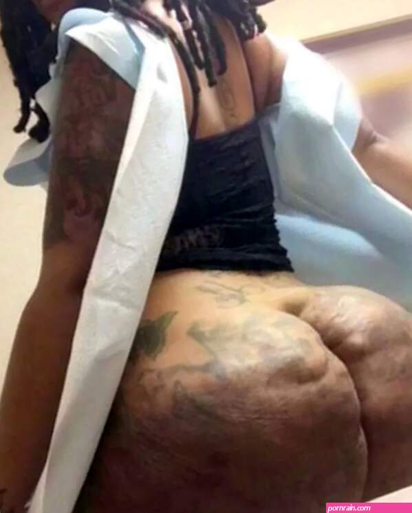 Miss Miami needs 60-inch butt amputated Botched docs say to fix it after illegal jabs went wrong